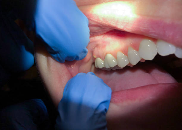 Best Emergency Wisdom Teeth Removal in Huntingdon, TN